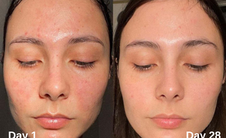 The Ultimate Guide to Radiant Skin: Unlocking the Power of Niacinamide & Kojic Acid Serum