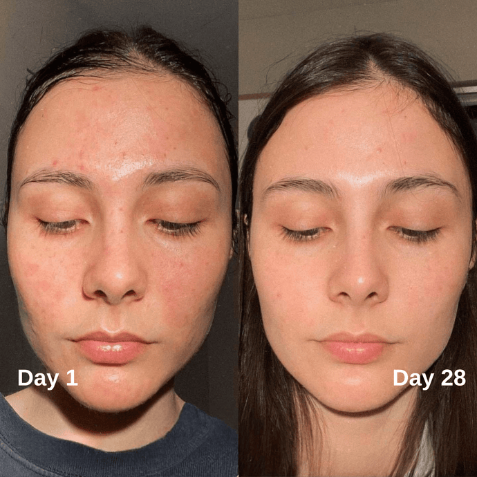 Niacinamide Kojic Acid Serum for Dark Spots | Active Drip